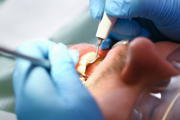 Best Emergency Dental Care for Abscessed Tooth in Springfield, CO